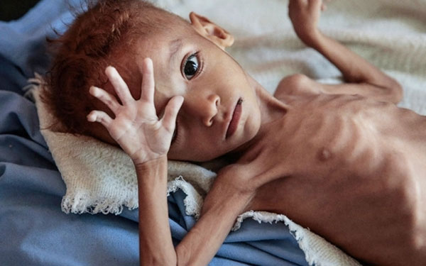 الصحة العالمية: الشعب اليمني على حافة المجاعة