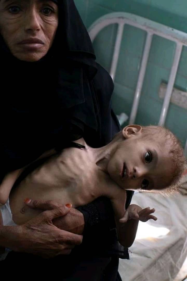 بالصور .. اخواننا العرب المسلمون يموتون جوعاً في اليمن