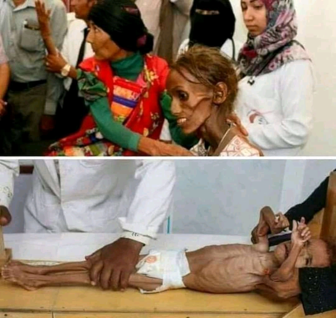 بالصور .. اخواننا العرب المسلمون يموتون جوعاً في اليمن