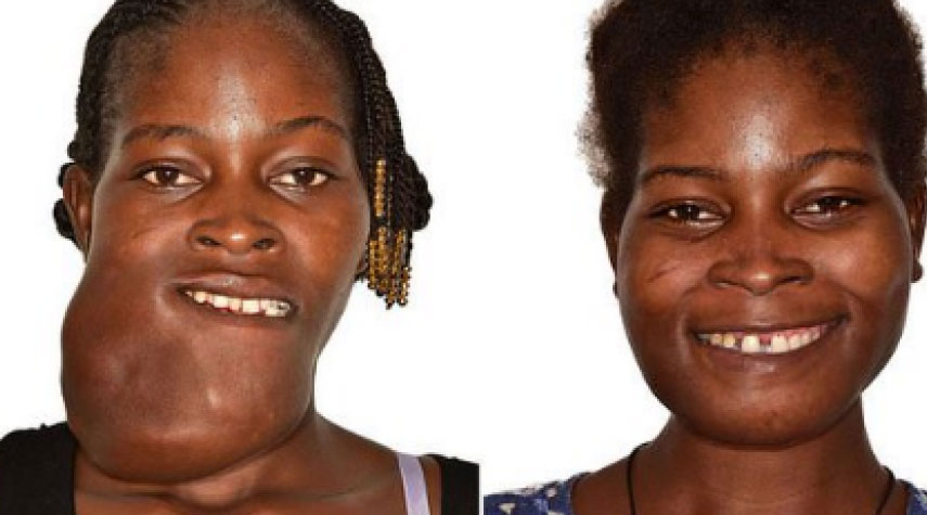 نهاية معاناة امرأة رُجمت في إفريقيا بسبب "وجهها"