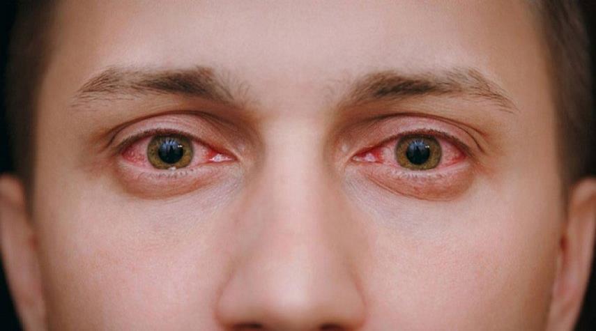 احذروا احمرار العين أثناء الاصابة بكورونا