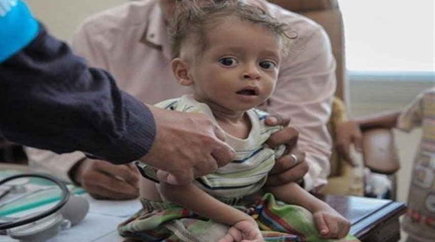 اليونيسف تحذر من ارتفاع عدد الأطفال الذين يعانون من سوء التغذية باليمن