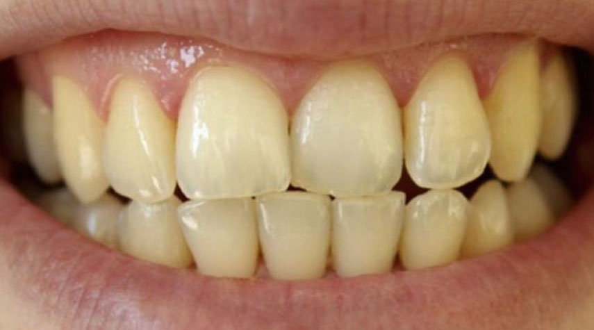 كيف نتخلص من البقع البنية على الأسنان؟