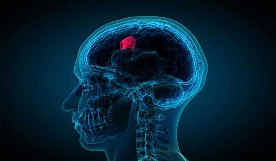 5 علامات رئيسية حول الصداع تحذر من وجود ورم في المخ!