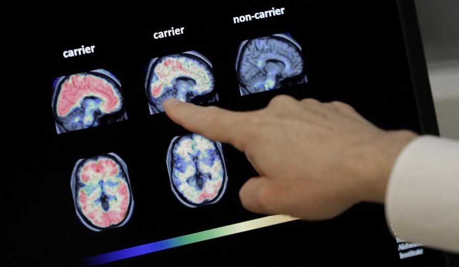 علماء يعثرون على "مفاجأة" في دماغي مريضين بالزهايمر