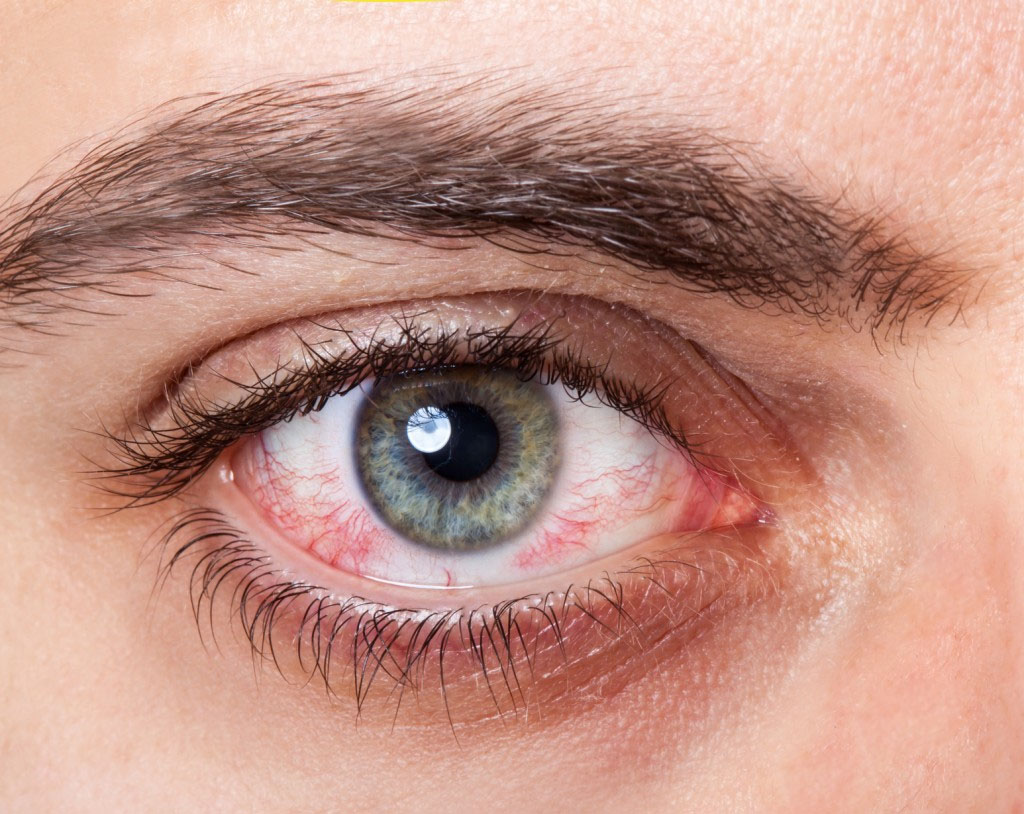 أعراض للإصابة بكورونا قد تظهر في عينيك