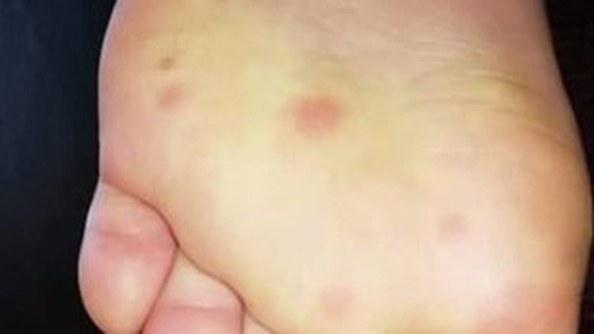 لماذا تظهر كدمات على جلد المصابين بـ "كوفيد-19"؟