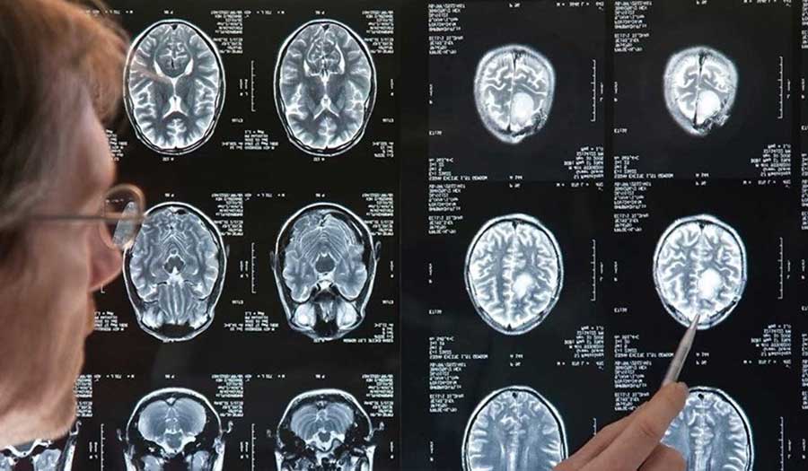 اكتشاف جديد قد يُحدث طفرة في علاج أمراض الدماغ