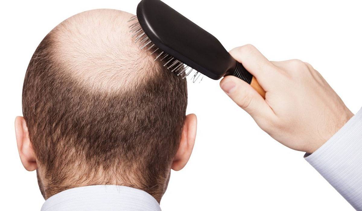 عوامل رئيسية لتساقط الشعر.. ما هي؟