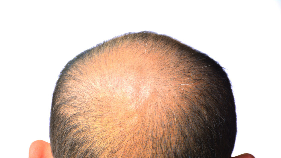 دواء جديد لاستعادة الشعر لدى المصابين بالصلع