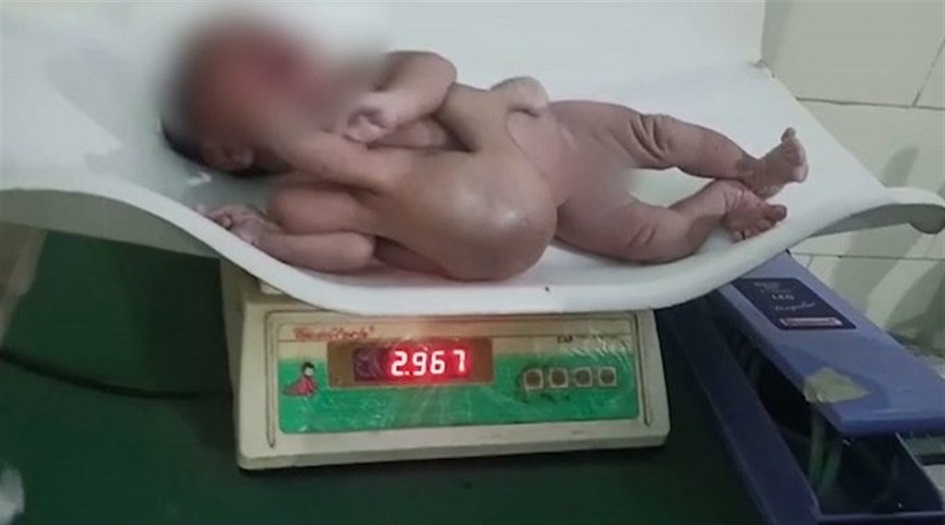 ولادة طفلة بـ 4 أذرع و4 أرجل في الهند