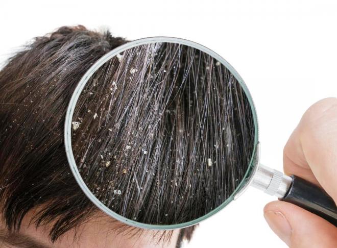 ما أفضل طريقة لعلاج قشرة الشعر نهائيا؟