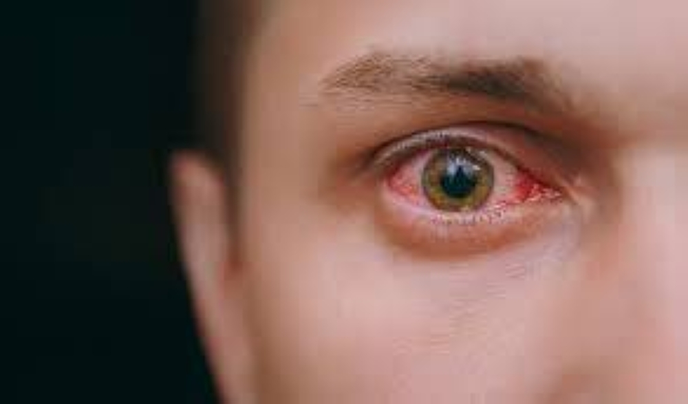 أسباب شائعة لاحمرار العين.. تعرف عليها