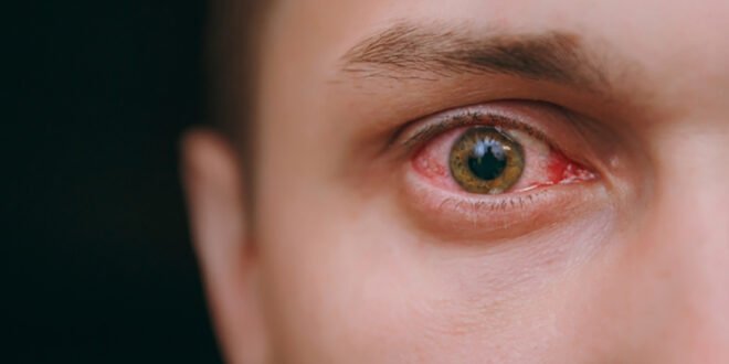 احمرار العين.. ما الذي يكشفه عن صحتك؟