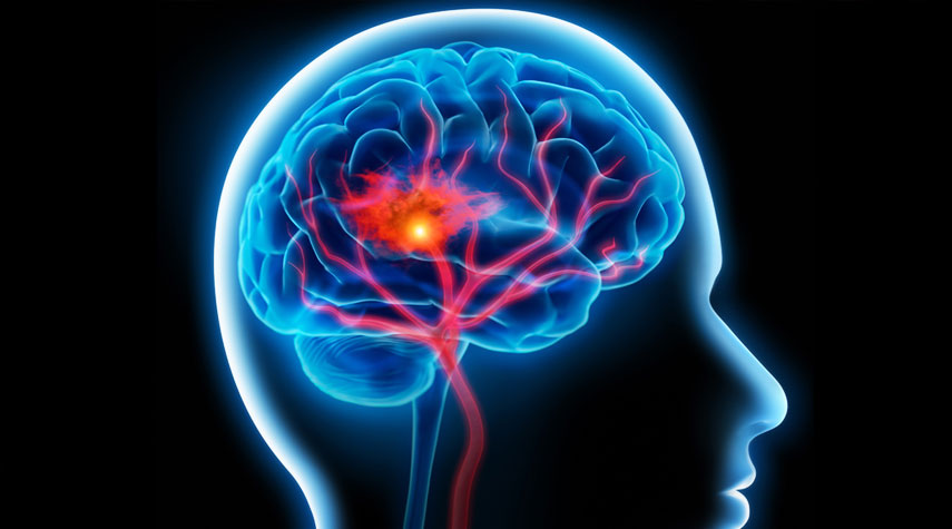 دراسة صينية تكشف طريقة لتحسين علاج السكتة الدماغية