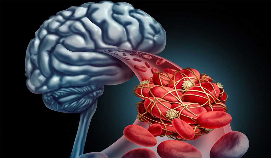إزالة الجلطات الدموية فور السكتة الدماغية تخفض معدلات الوفاة وتحسن صحة المرضى
