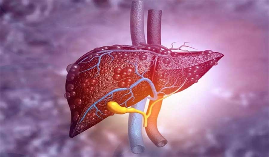 مرضى "كوفيد-19" يتعرضون لإصابة الكبد بعد أشهر من العدوى