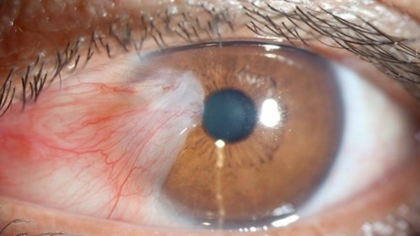 تعرف على أعراض سرطان العين!