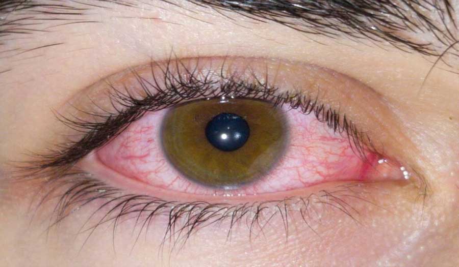 ما هي متلازمة جفاف العين.. أسبابها وعلاجها؟