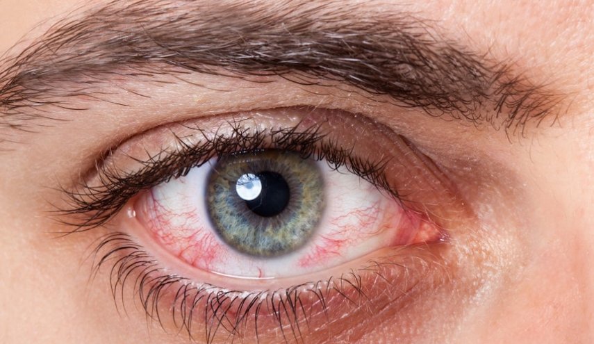 أسباب التهاب العيون في الربيع.. تعرف عليها