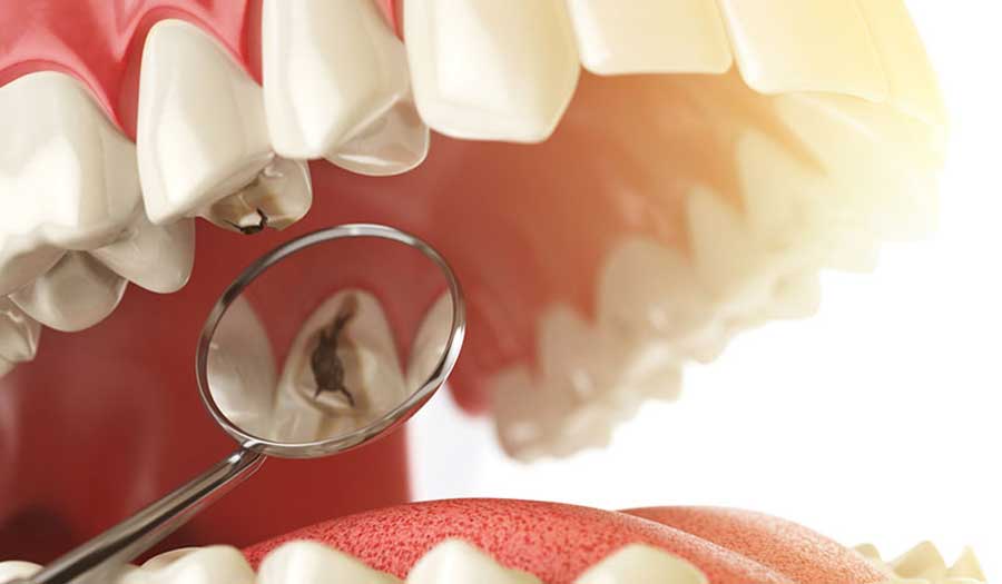 علماء يتوصلون لعلاج "تسوس الأسنان"