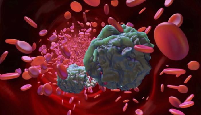 علاج جديد يستهدف أشرس أنواع سرطان الدم
