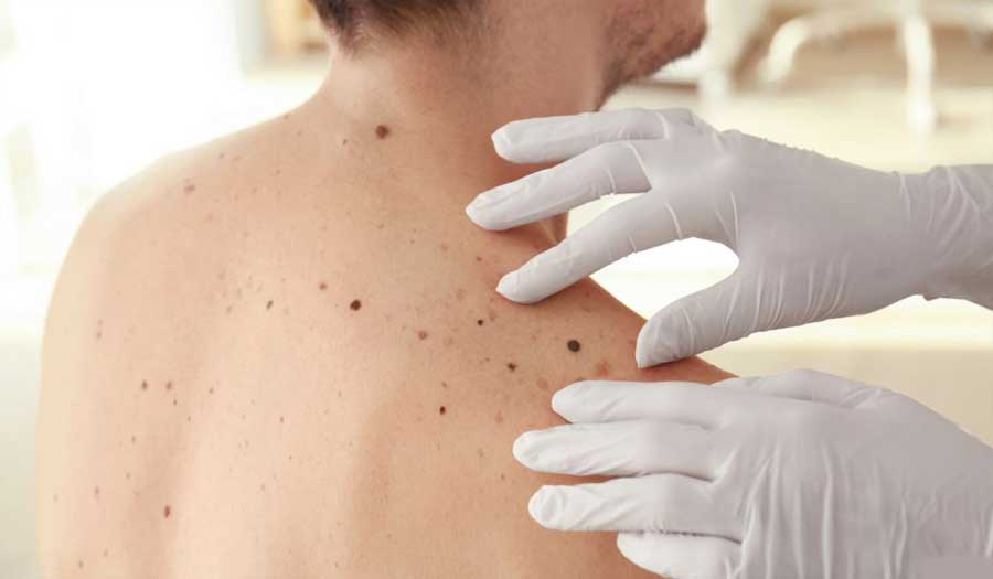 ما علاقة التقدم في العمر بانتشار سرطان الجلد؟