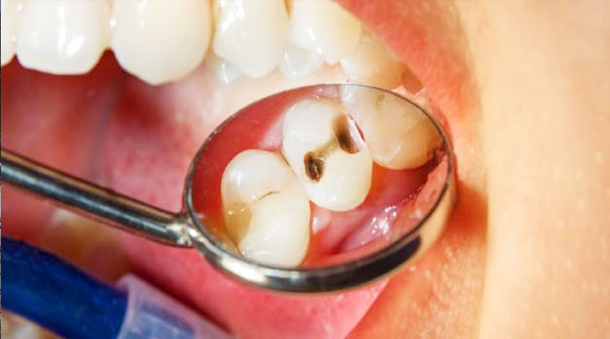 تجنب هذه المواد لأنها تدمر الأسنان